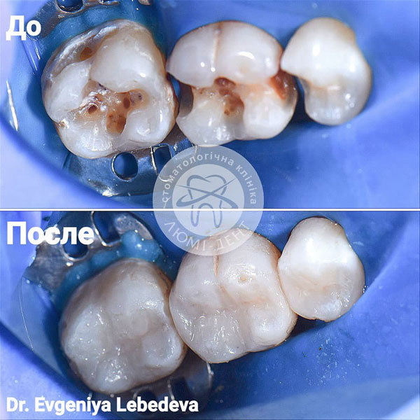 Восстановление зубов. Фото предоставлено: www.lumident.kiev.ua